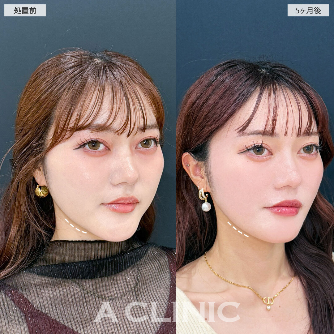 1day小顔脂肪吸引でアゴ下のもたつきがなくなり、フェイスラインがスッキリしました！処置前と5ヶ月後の症例です(20代女性)