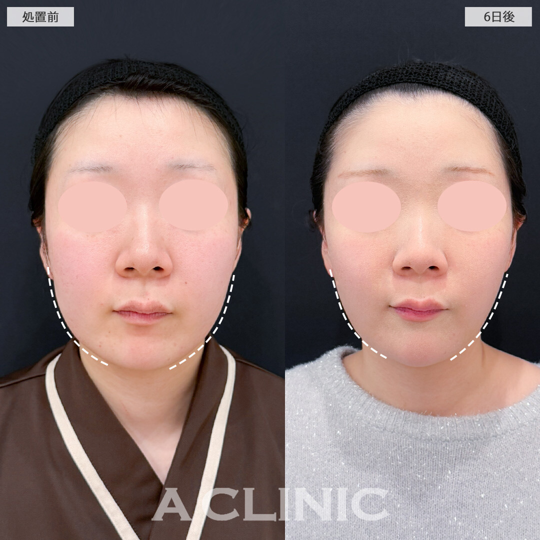 1day小顔脂肪吸引とバッカルファット除去術は術後6日でここまでスッキリ感を実感できます！処置前と6日後の症例です(20代女性)