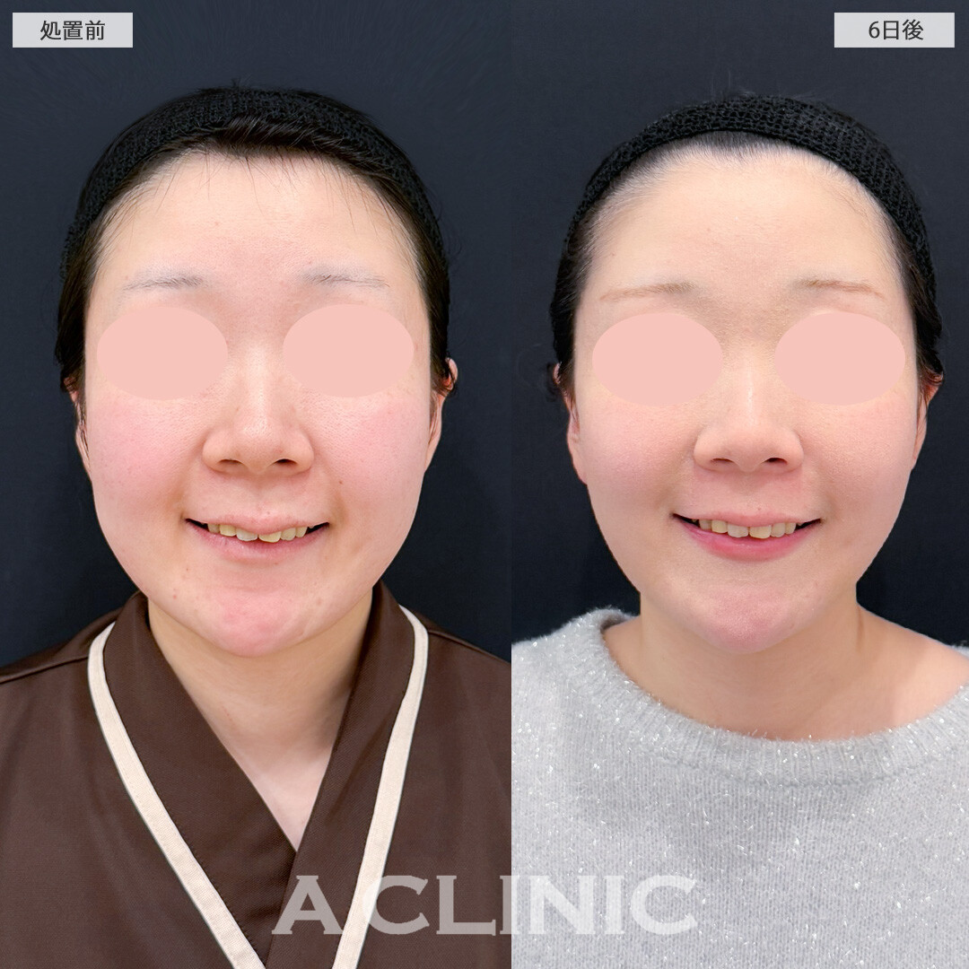 1day小顔脂肪吸引とバッカルファット除去術は術後6日でここまでスッキリ感を実感できます！処置前と6日後の症例です(20代女性)