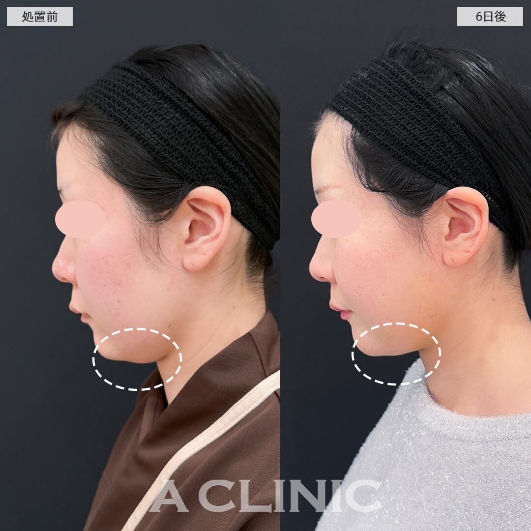 1day小顔脂肪吸引とバッカルファット除去術は術後6日でここまでスッキリ感を実感できます！処置前と6日後の症例です(20代女性)
