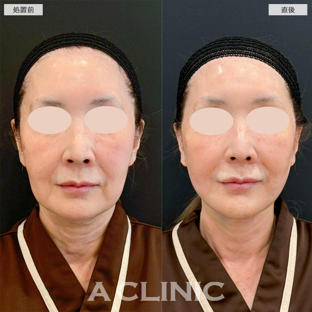 1day小顔脂肪吸引で直後からたるみが解消され若々しい印象に！処置前と直後の症例です(60代女性)