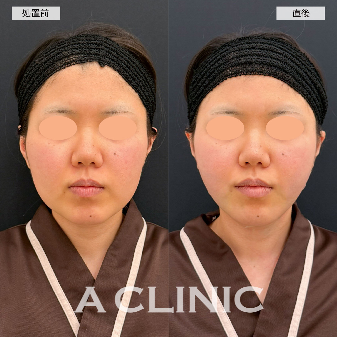 1day小顔脂肪吸引なら直後から腫れ最小限で小顔になれます！こちら処置前と直後の症例です(20代女性)
