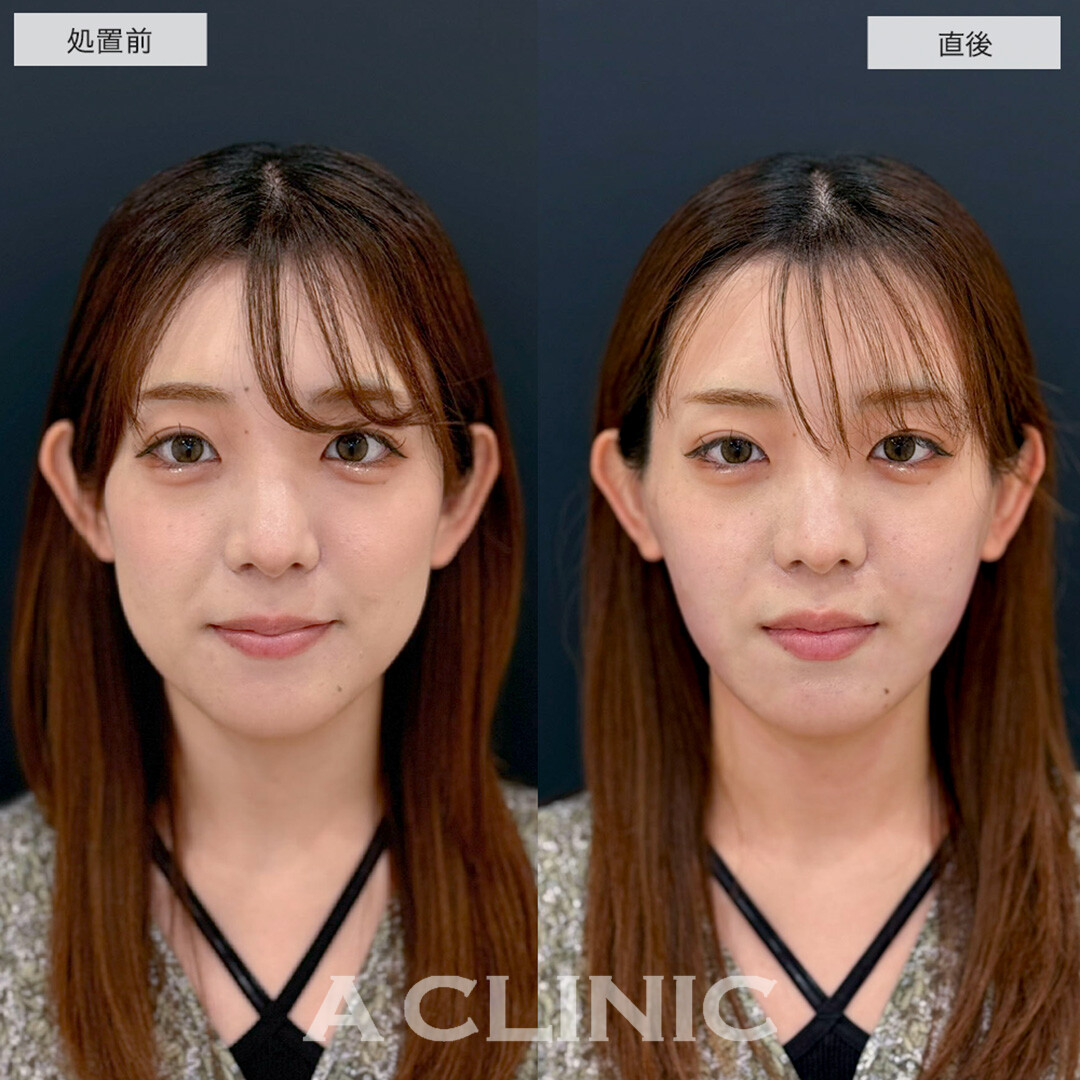 1day小顔脂肪吸引で直後から下膨れ顔改善しました!こちら処置前と直後の症例です(20代女性)