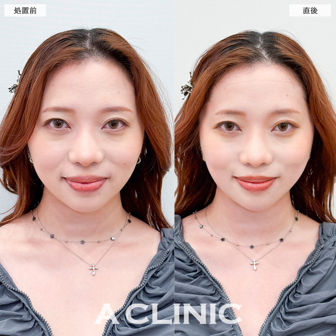 1day小顔脂肪吸引なら直後から固定バンド不要で腫れも最小限です！処置前と直後の症例です(30代女性)