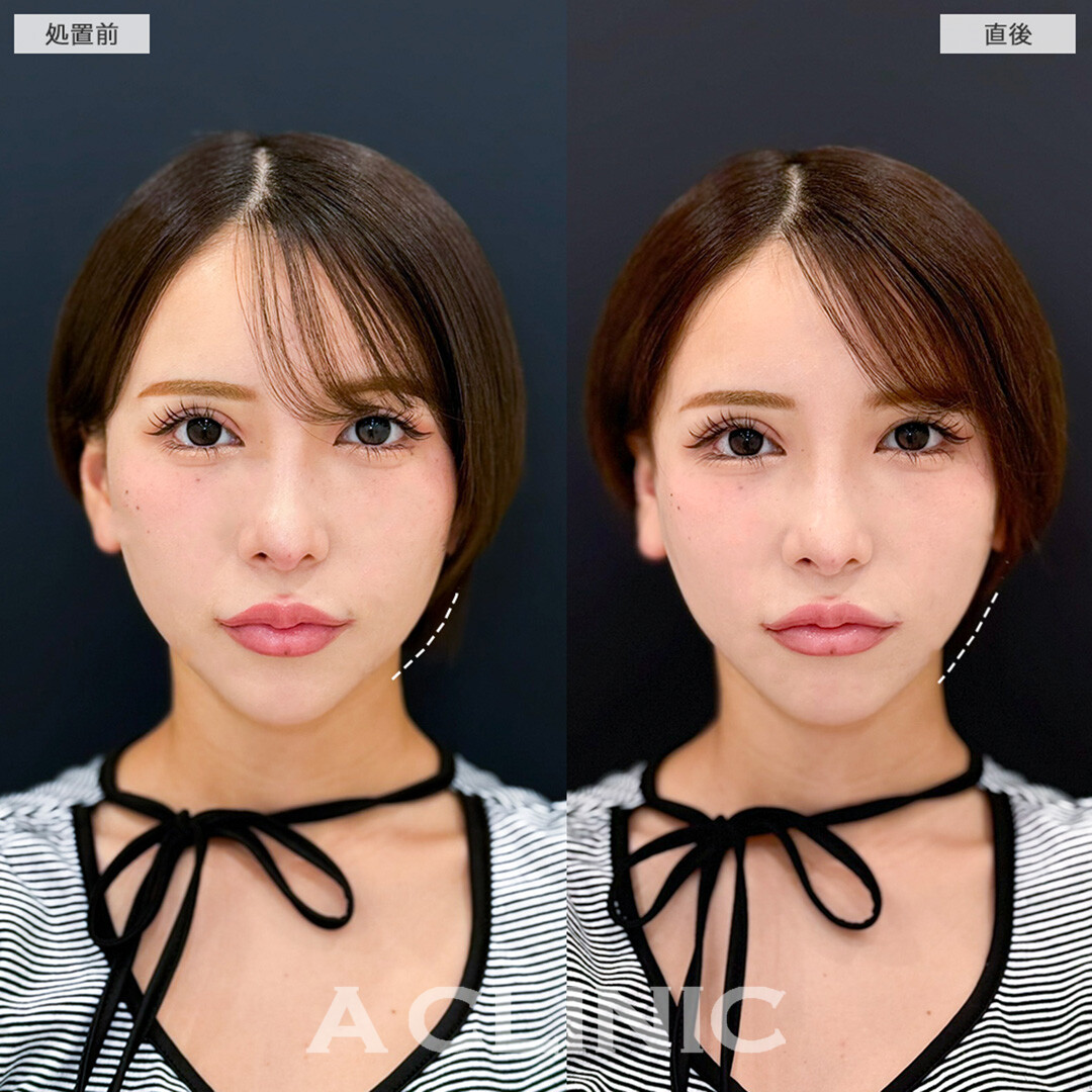 Aスレッドでリフトアップして即日小顔レベルアップへ!こちら処置前と直後の症例です(20代女性)