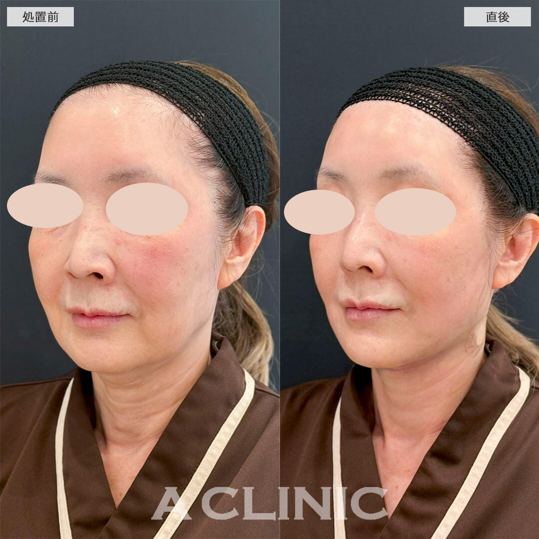 1day小顔脂肪吸引で直後からたるみが解消され若々しい印象に！処置前と直後の症例です(60代女性)