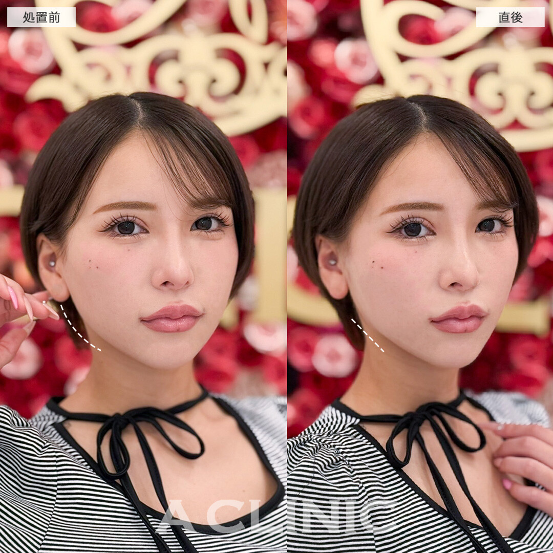 Aスレッドでリフトアップして即日小顔レベルアップへ!こちら処置前と直後の症例です(20代女性)