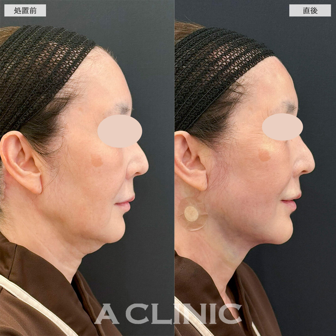 1day小顔脂肪吸引で直後からたるみが解消され若々しい印象に！処置前と直後の症例です(60代女性)