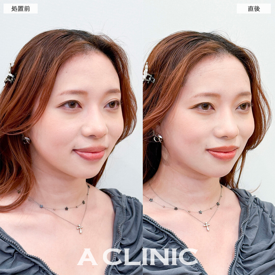 1day小顔脂肪吸引なら直後から固定バンド不要で腫れも最小限です！処置前と直後の症例です(30代女性)