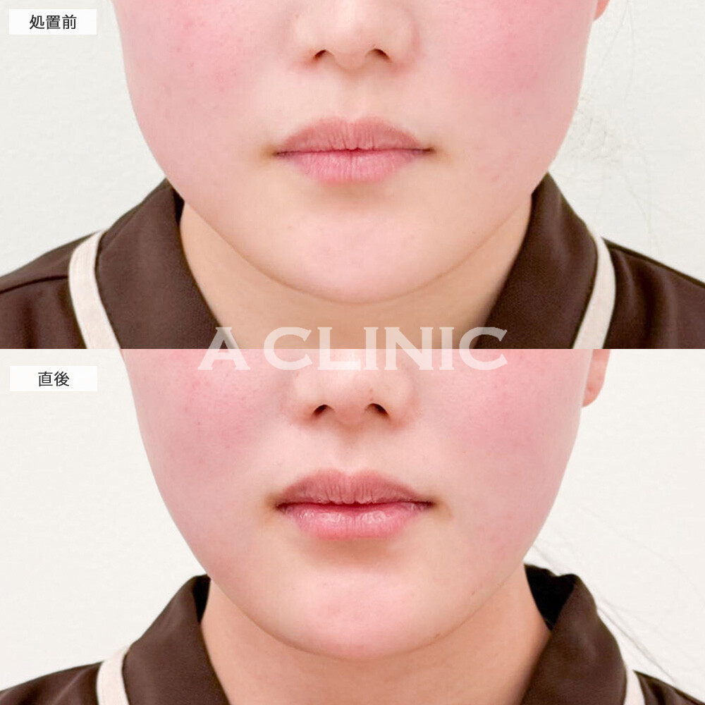 1day小顔脂肪吸引なら術直後でここまでスッキリ！こちら処置前から1週間後の症例です(20代女性)