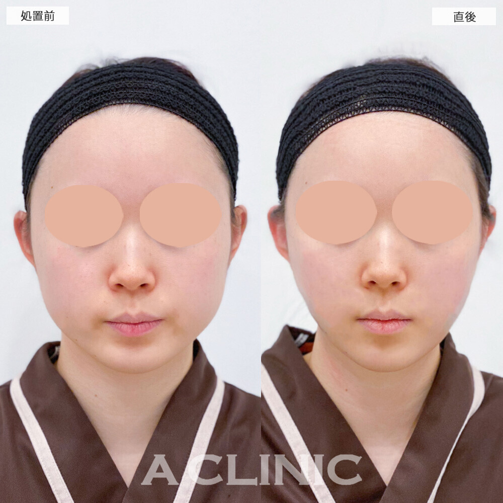 1day小顔脂肪吸引で下膨れ顔が解消！こちら処置前と直後の症例です(20代女性)