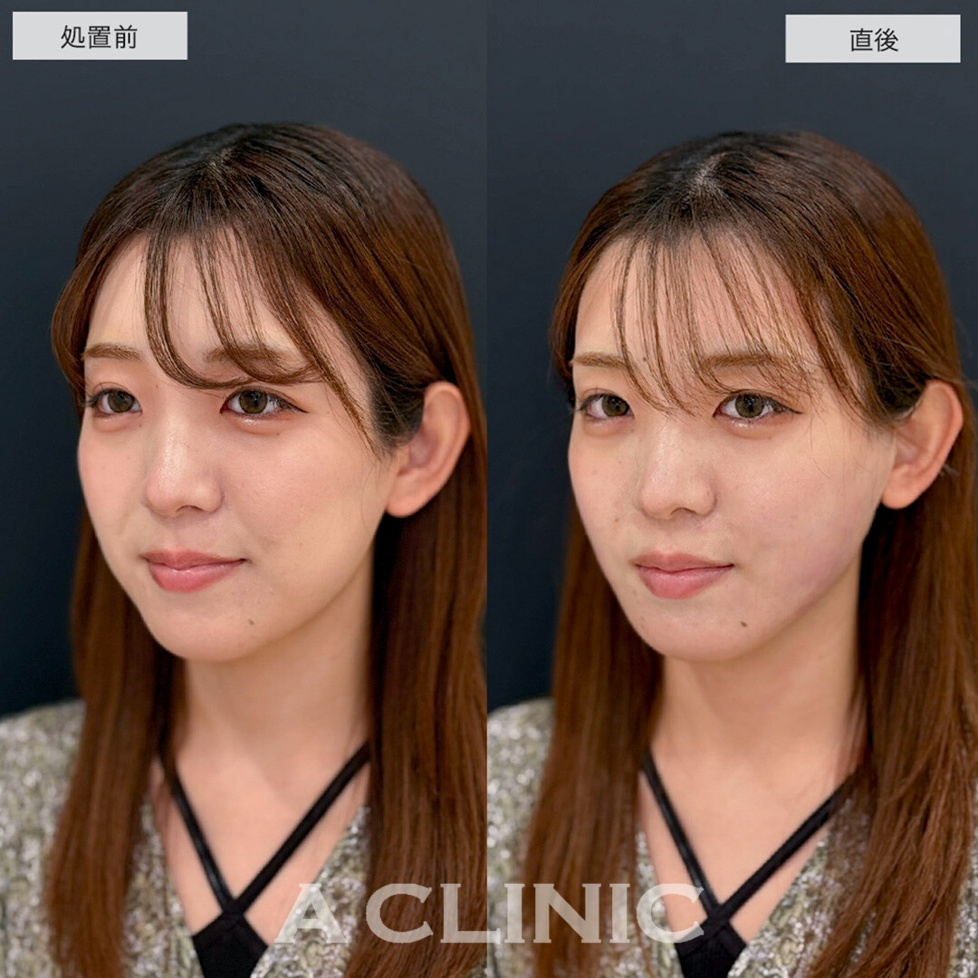 1day小顔脂肪吸引で直後から下膨れ顔改善しました!こちら処置前と直後の症例です(20代女性)