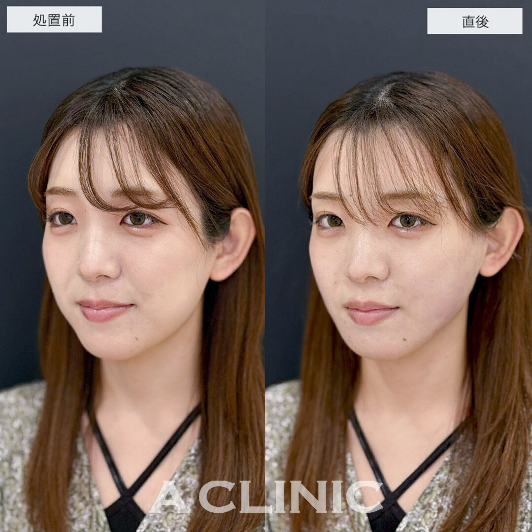 1day小顔脂肪吸引で直後から下膨れ顔改善しました!こちら処置前と直後の症例です(20代女性)
