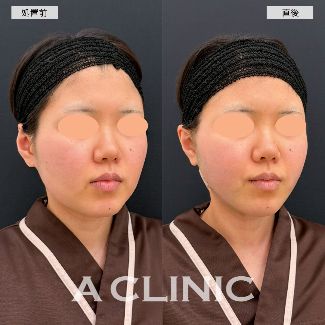 1day小顔脂肪吸引なら直後から腫れ最小限で小顔になれます！こちら処置前と直後の症例です(20代女性)