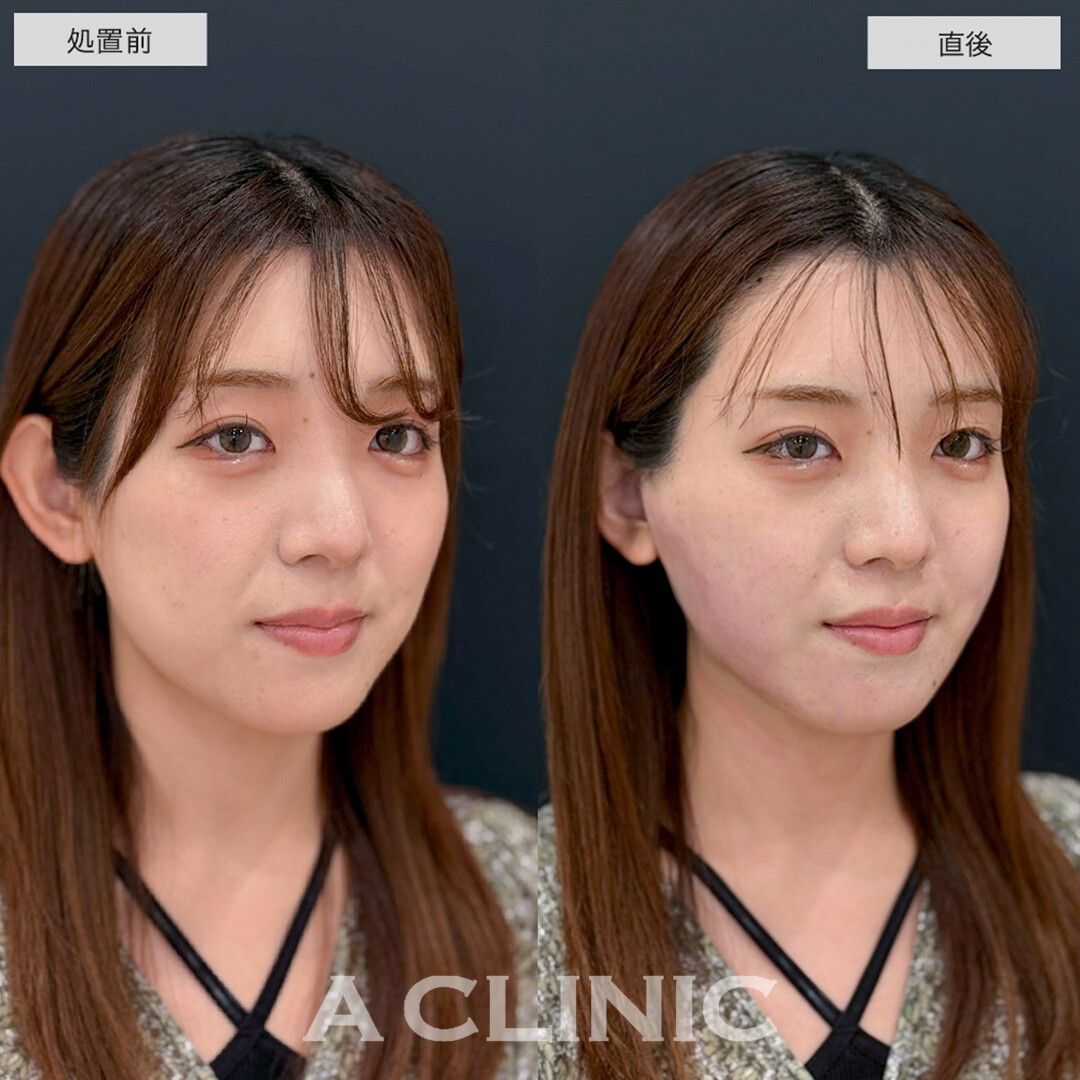 1day小顔脂肪吸引で直後から下膨れ顔改善しました!こちら処置前と直後の症例です(20代女性)