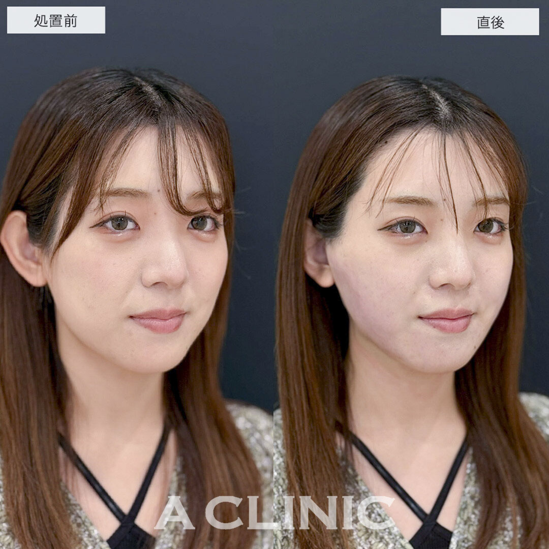 1day小顔脂肪吸引で直後から下膨れ顔改善しました!こちら処置前と直後の症例です(20代女性)