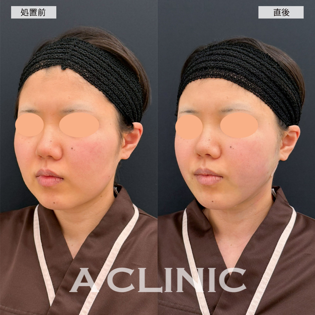 1day小顔脂肪吸引なら直後から腫れ最小限で小顔になれます！こちら処置前と直後の症例です(20代女性)