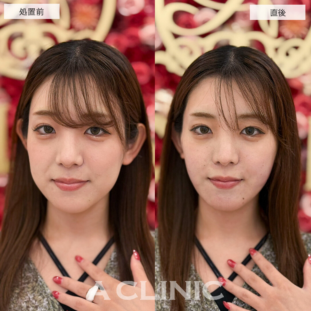 1day小顔脂肪吸引で直後から下膨れ顔改善しました!こちら処置前と直後の症例です(20代女性)