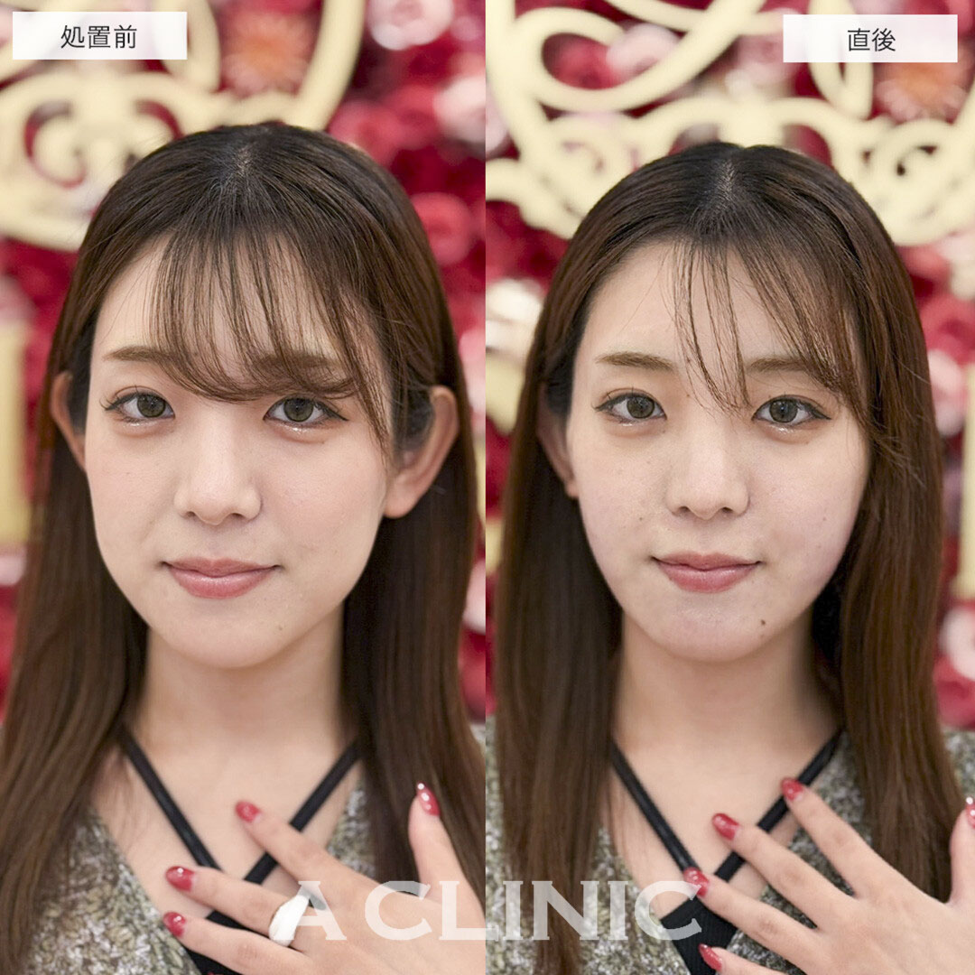 1day小顔脂肪吸引で直後から下膨れ顔改善しました!こちら処置前と直後の症例です(20代女性)