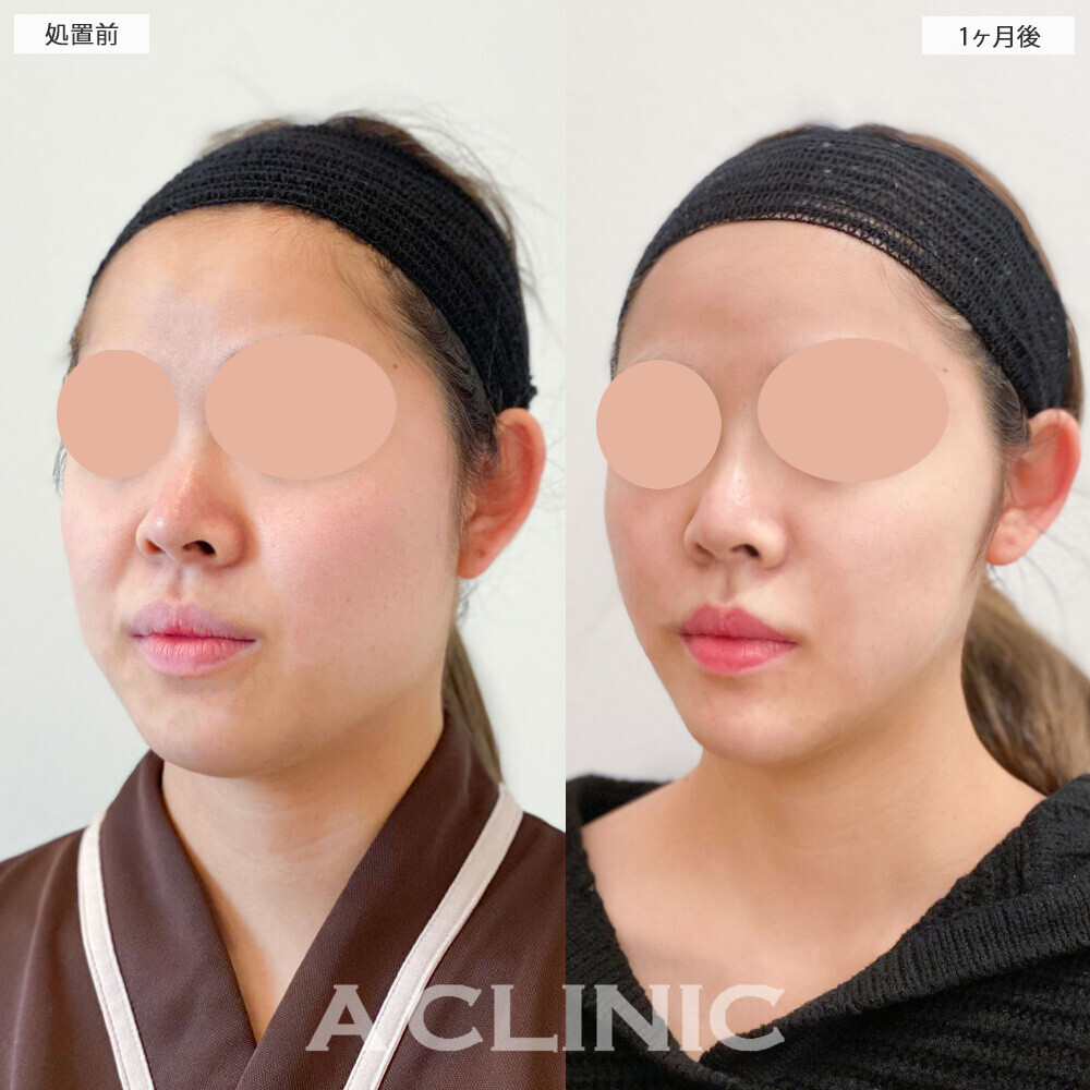 1day小顔脂肪吸引と小顔エラボトックスで丸顔からVフェイスに変化！こちら処置前と1ヶ月後の症例です(20代女性)