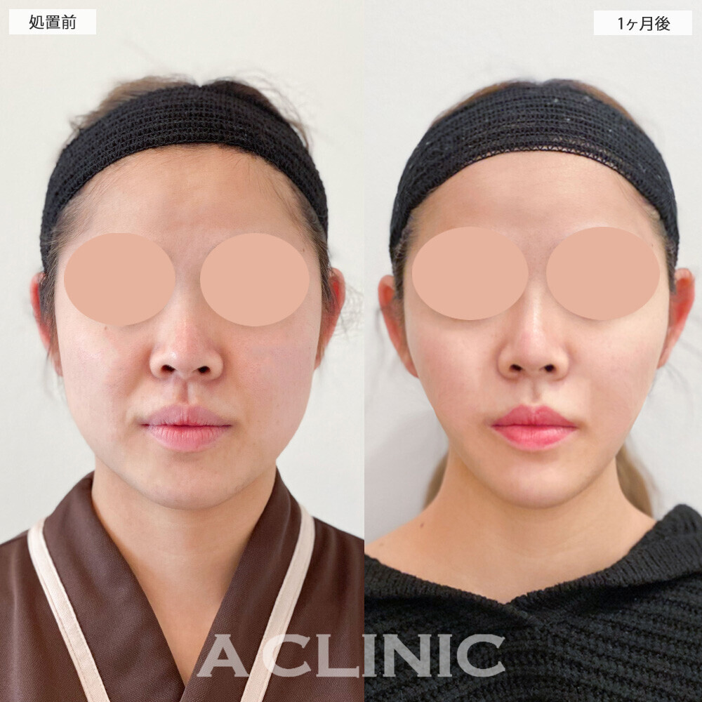 1day小顔脂肪吸引と小顔エラボトックスで丸顔からVフェイスに変化！こちら処置前と1ヶ月後の症例です(20代女性)