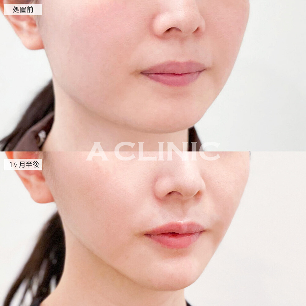 1day小顔脂肪吸引と小顔エラボトックスとあごへのヒアルロン酸注入を組み合わせることで丸顔を解消し綺麗な卵型の輪郭に！こちら処置前と1ヶ月半後の症例です(20代女性)