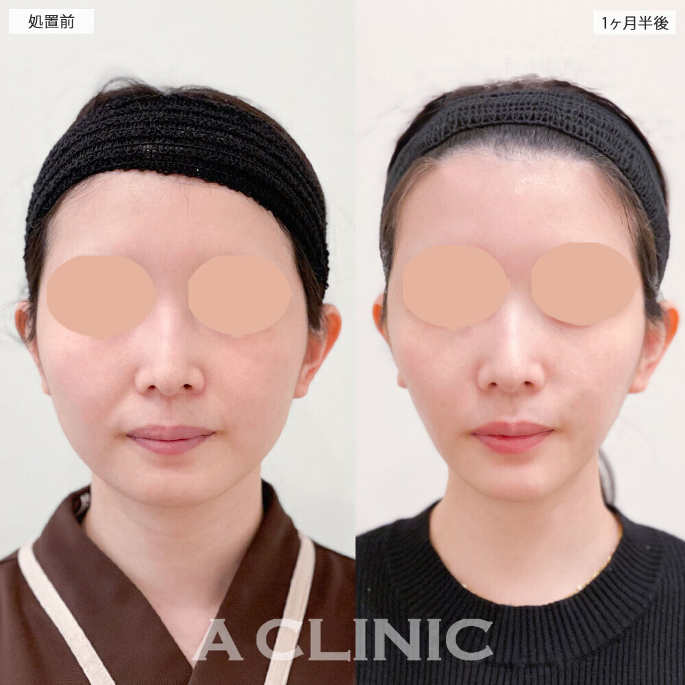 1day小顔脂肪吸引と小顔エラボトックスとあごへのヒアルロン酸注入を組み合わせることで丸顔を解消し綺麗な卵型の輪郭に！こちら処置前と1ヶ月半後の症例です(20代女性)