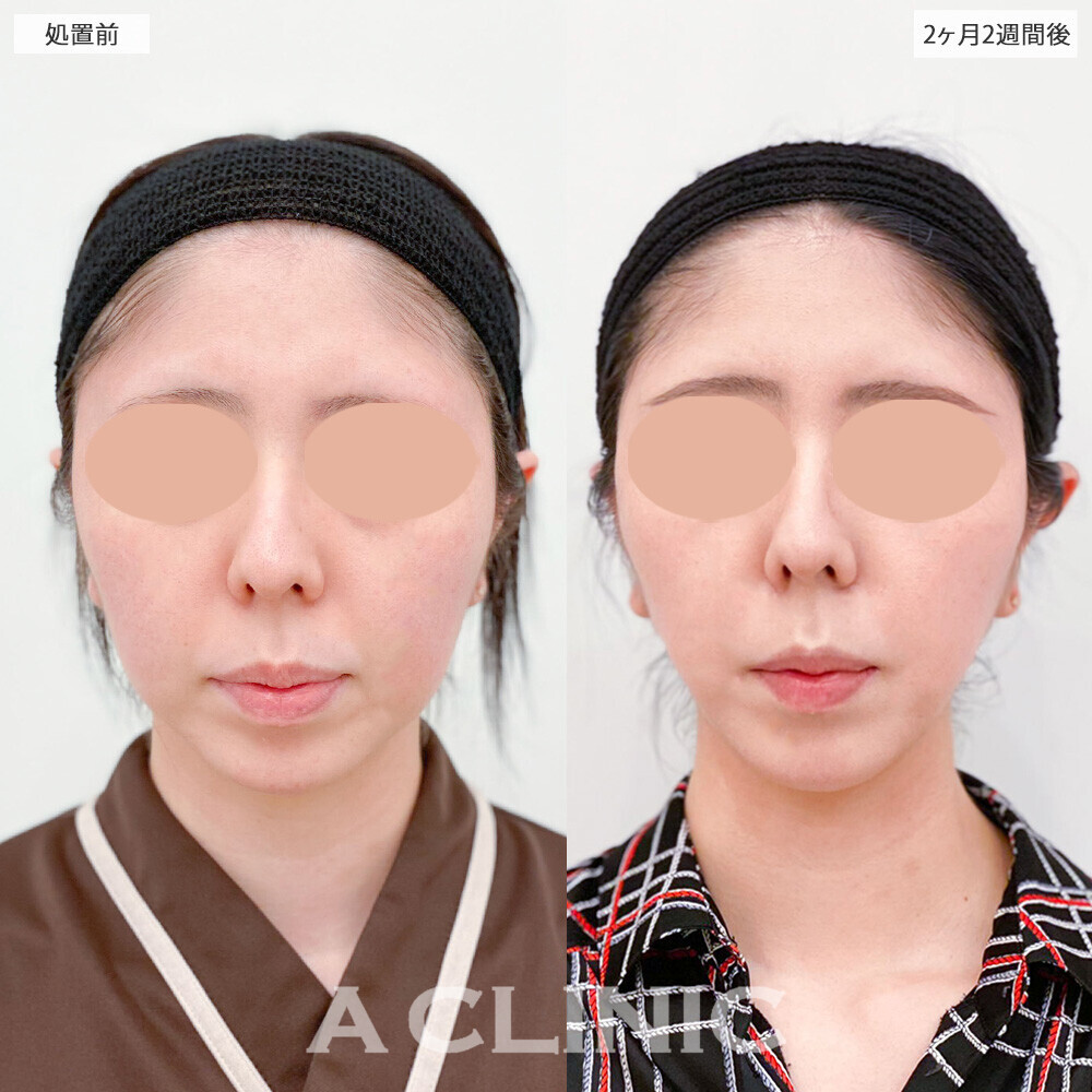 1day小顔脂肪吸引で加工無しでもVフェイスに！こちら処置前から2ヶ月2週間後の症例です(20代女性)