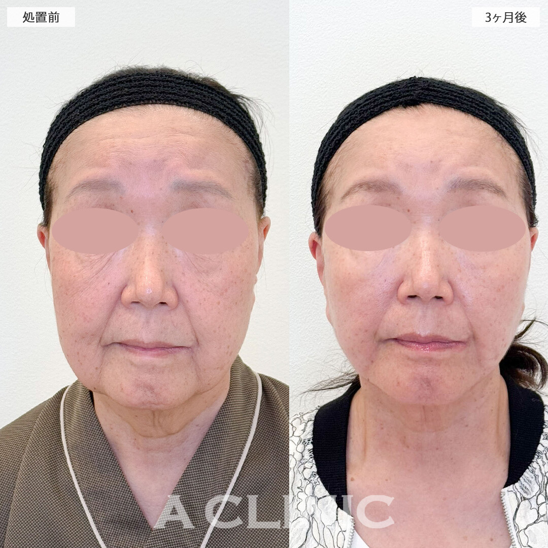 A式美肌たるみ切開と1day小顔脂肪吸引で傷跡目立たず若返り！こちら処置前と3ヶ月後の症例です(70代女性)