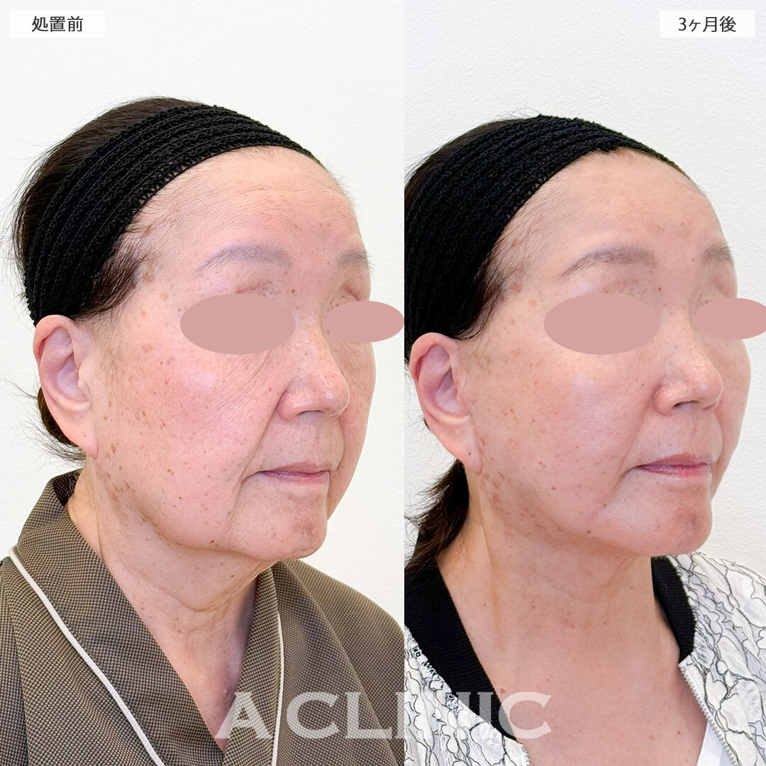 A式美肌たるみ切開と1day小顔脂肪吸引で傷跡目立たず若返り！こちら処置前と3ヶ月後の症例です(70代女性)