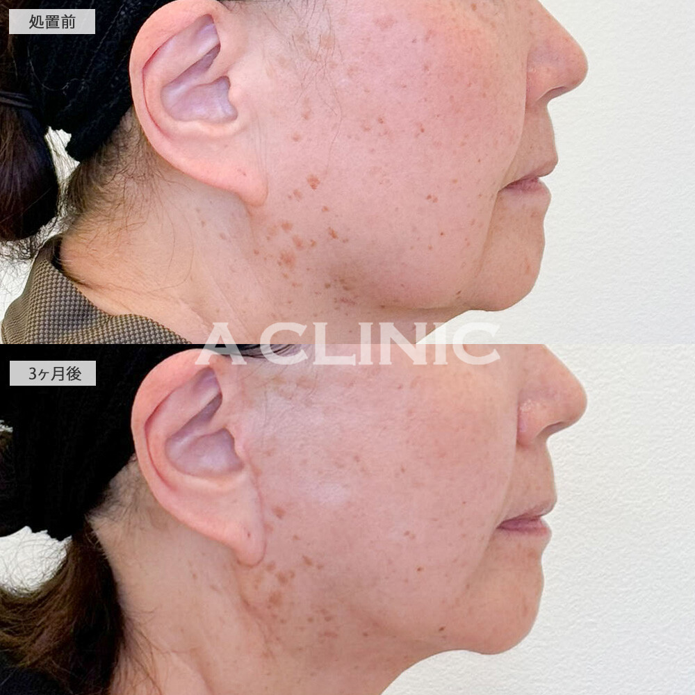 A式美肌たるみ切開と1day小顔脂肪吸引で傷跡目立たず若返り！こちら処置前と3ヶ月後の症例です(70代女性)