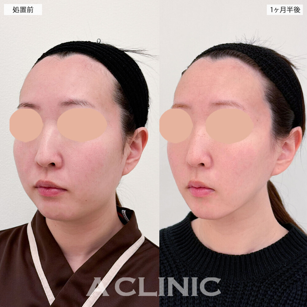 1day小顔脂肪吸引と小顔エラボトックスで口周りのもたつきがなくなり褒められる輪郭に！こちら処置前と1ヶ月半後の症例です(20代女性)