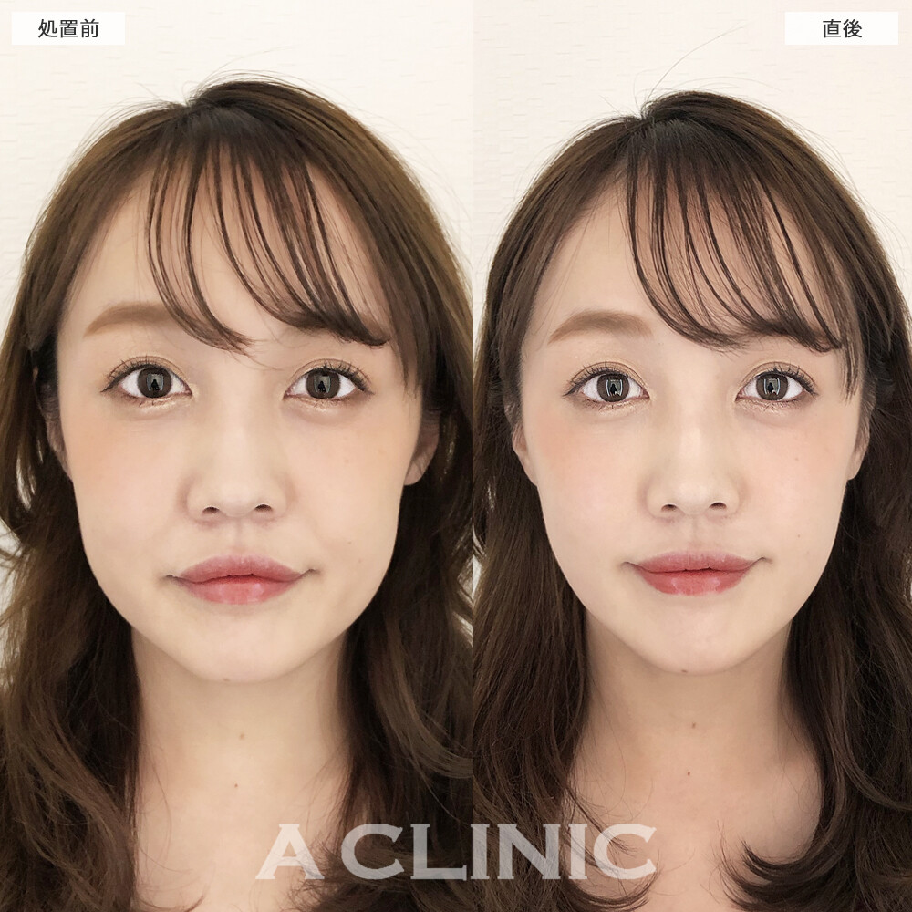 輪郭のたるみを15分で撃退！Aスレッドの処置前と直後の症例です(20代女性)