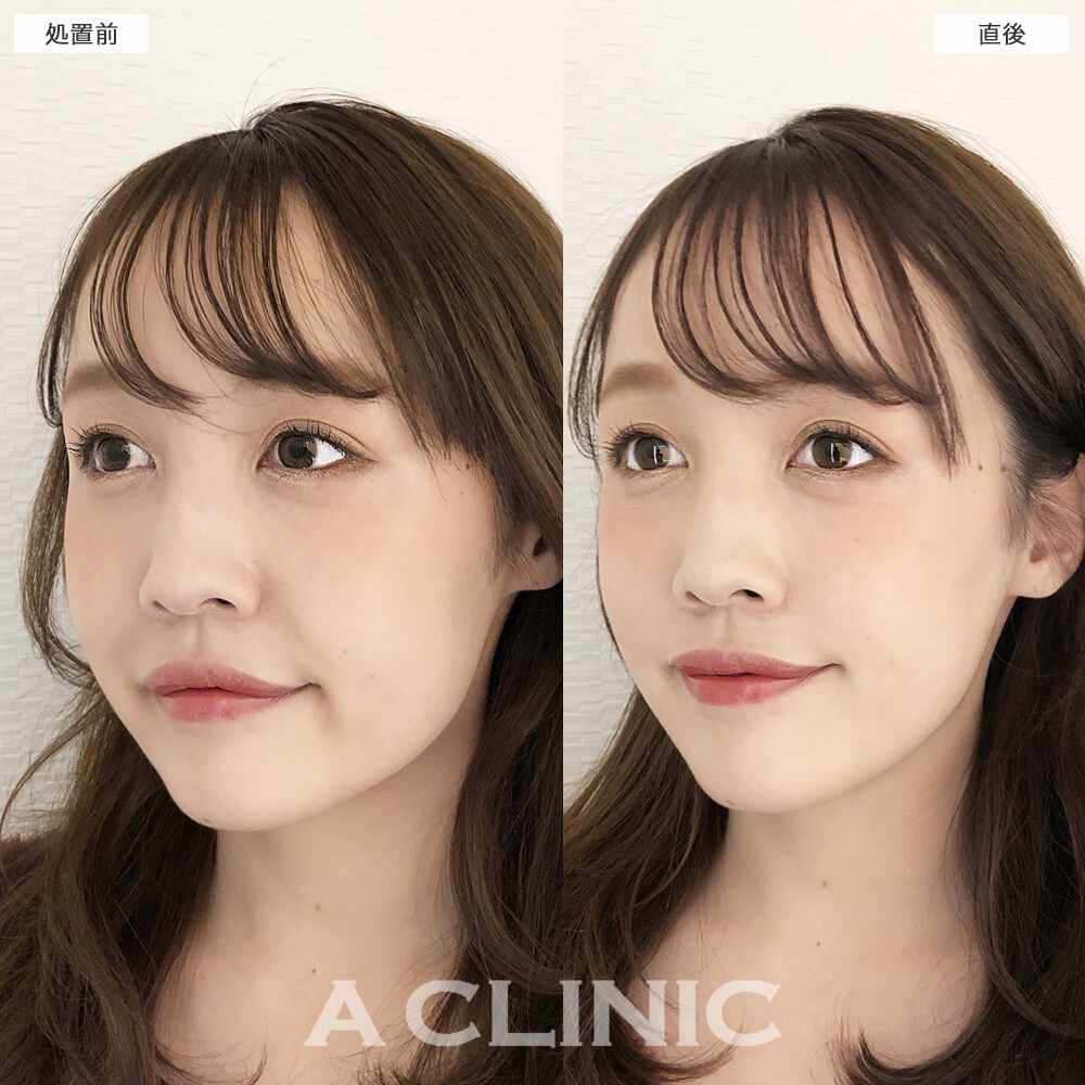 輪郭のたるみを15分で撃退！Aスレッドの処置前と直後の症例です(20代女性)