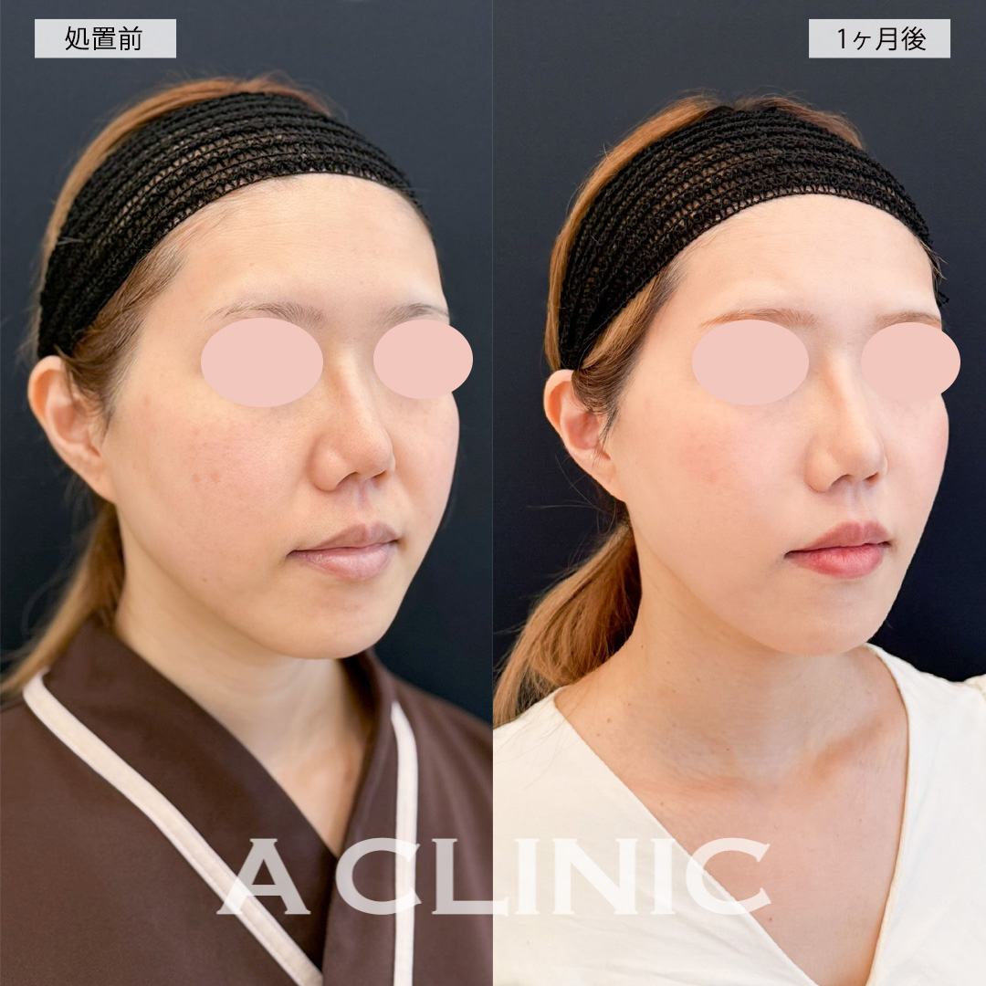 1day小顔脂肪吸引で輪郭の下膨れが改善されました！こちら処置前と1ヶ月後の症例です(30代女性)
