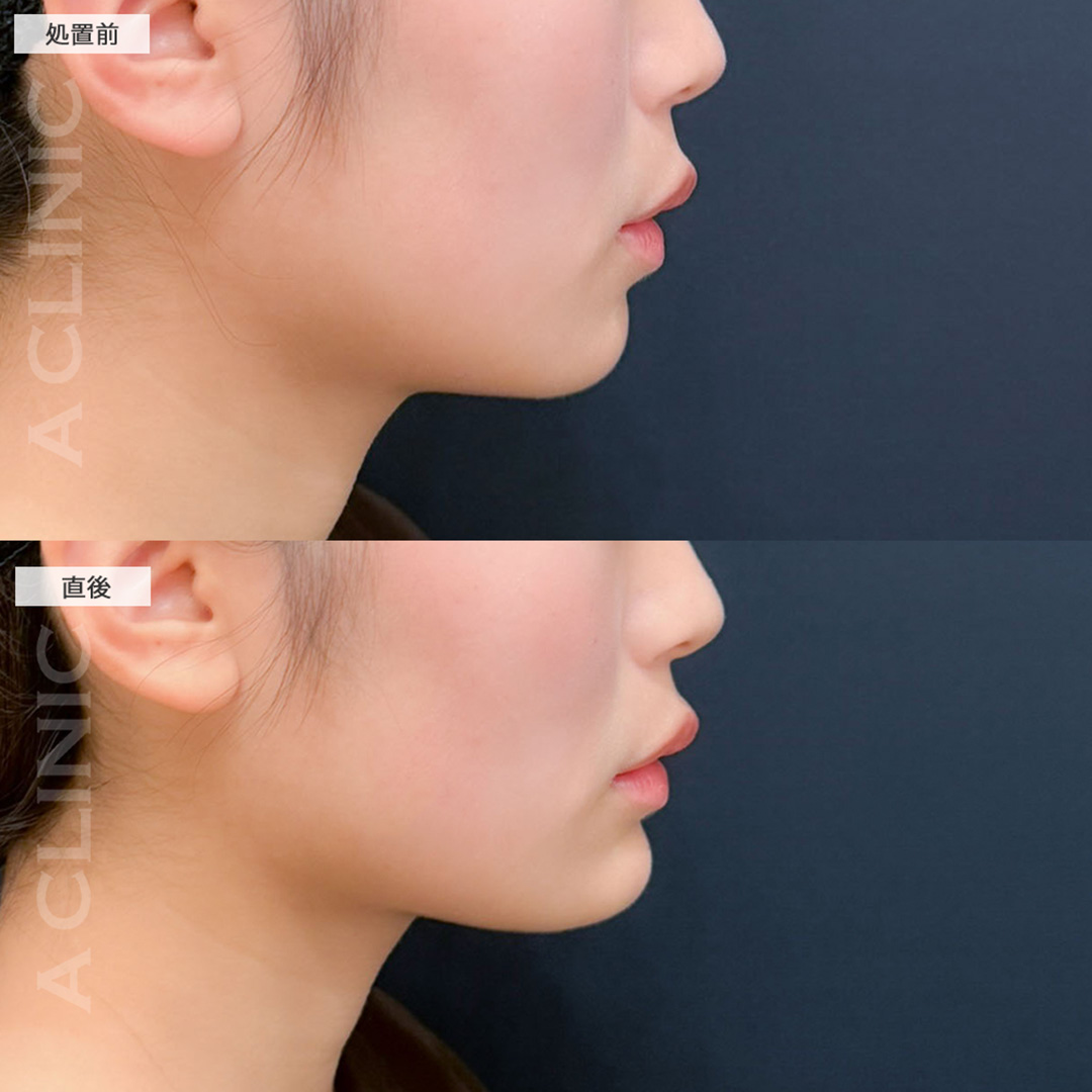 あごへのヒアルロン酸注入で即日横顔が立体的に整います！こちら処置前と直後の症例です(20代女性)