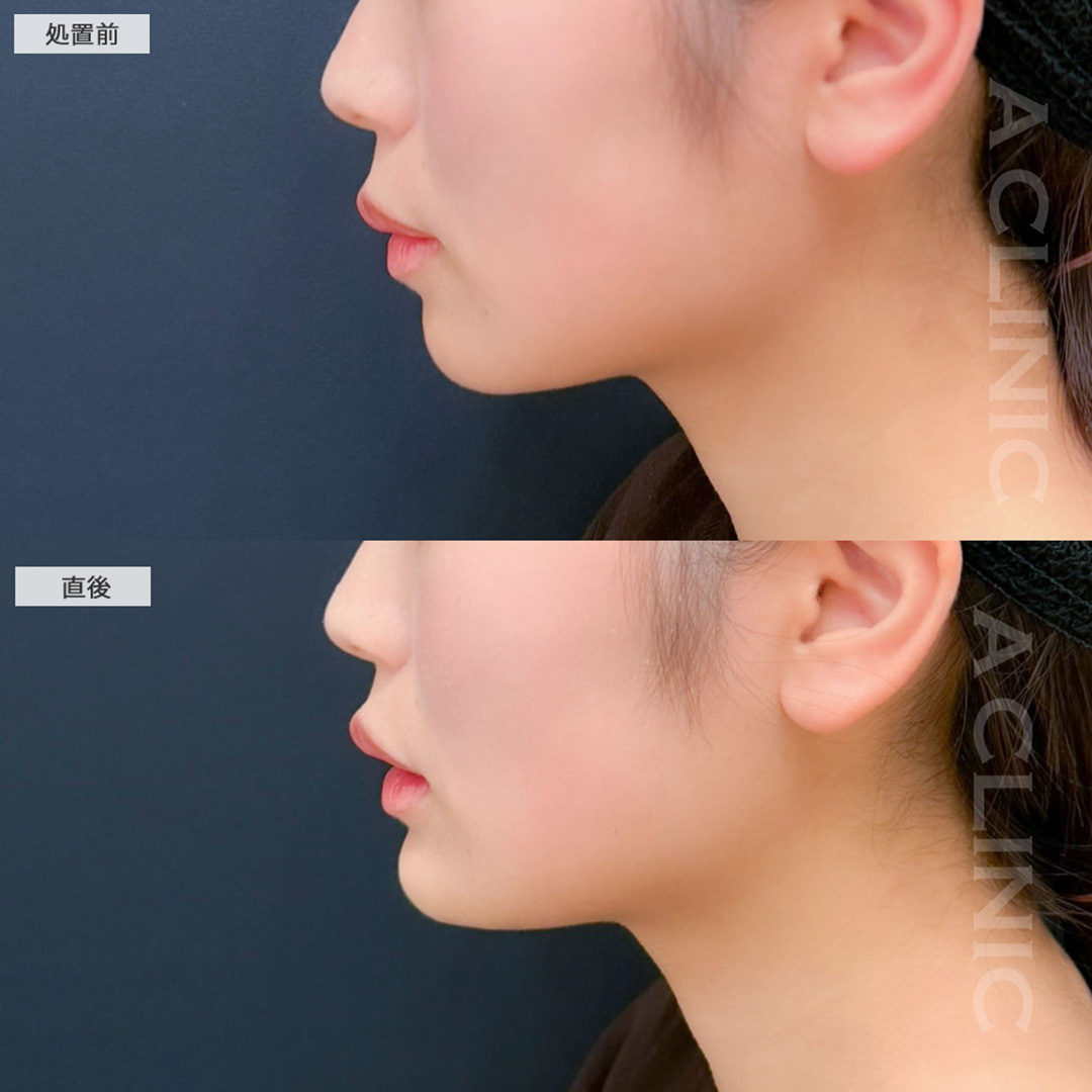 あごへのヒアルロン酸注入で即日横顔が立体的に整います！こちら処置前と直後の症例です(20代女性)