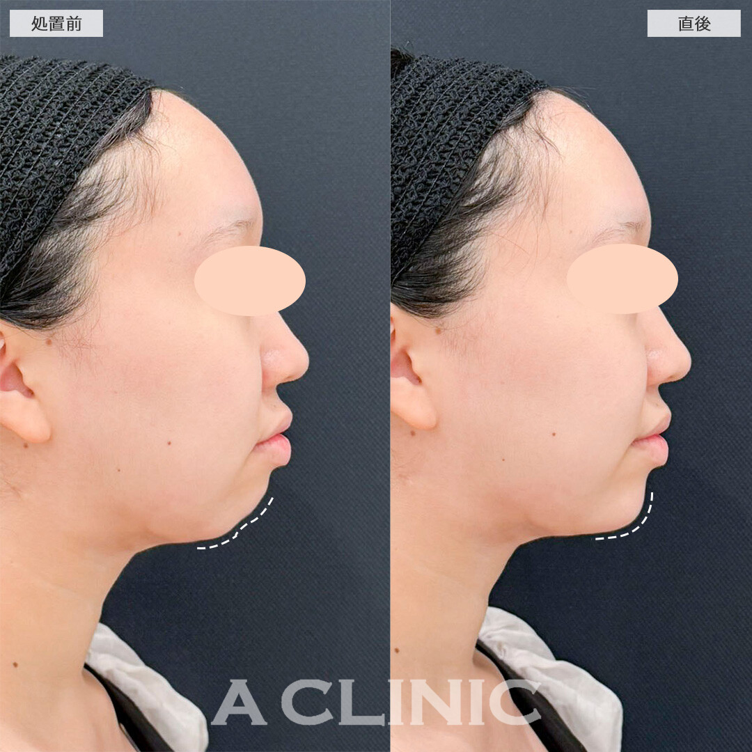 あごへのヒアルロン酸注入で口元の突出感が改善！処置前と直後の症例です(20代女性)
