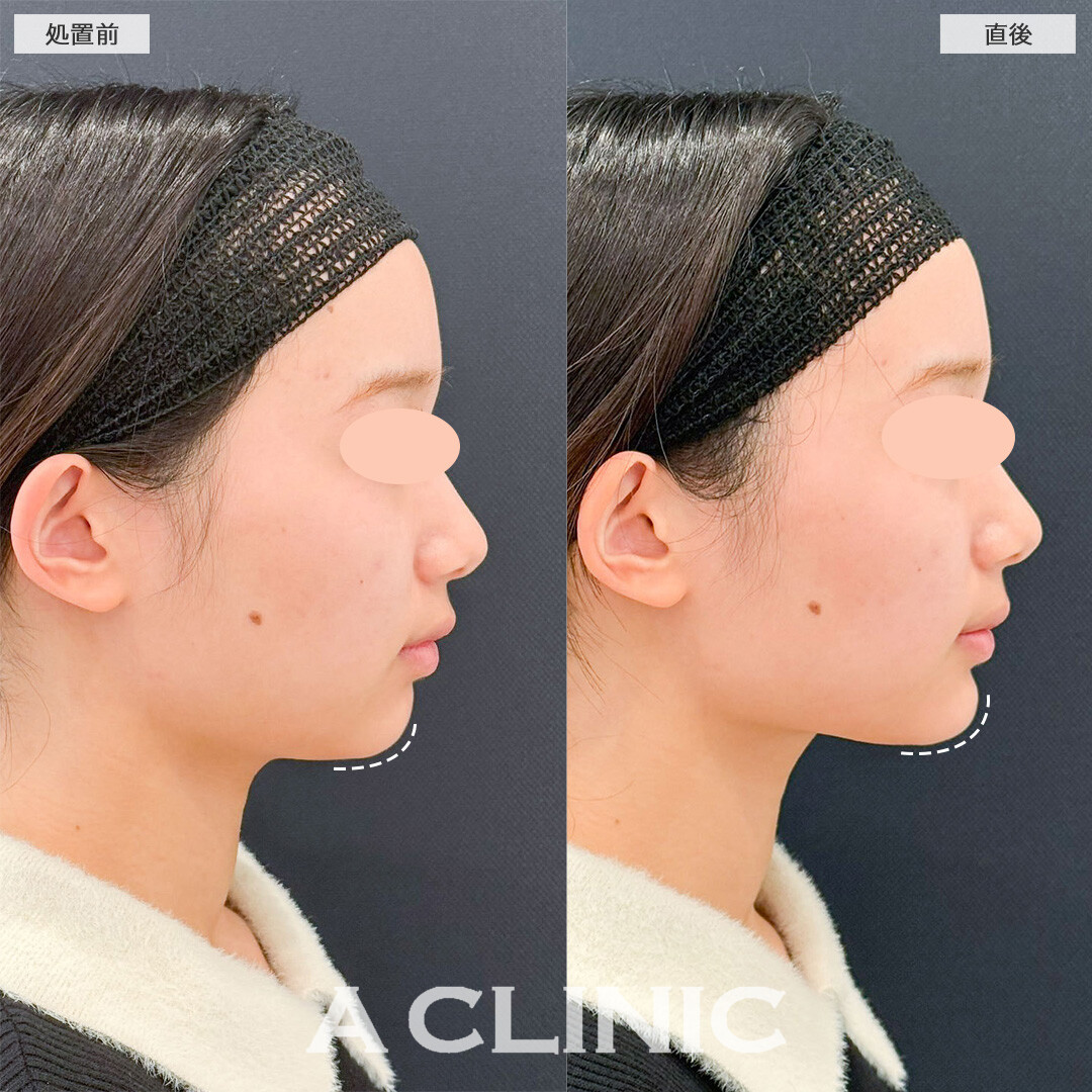 あごへのヒアルロン酸注入で理想のEラインに！こちら処置前と直後の症例です(20代女性)