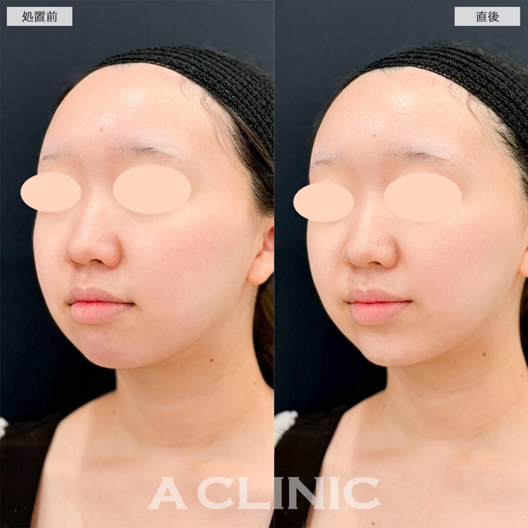 あごへのヒアルロン酸注入で口元の突出感が改善！処置前と直後の症例です(20代女性)