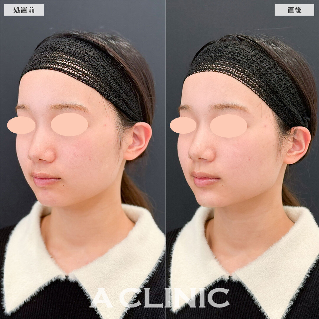 あごへのヒアルロン酸注入で理想のEラインに！こちら処置前と直後の症例です(20代女性)