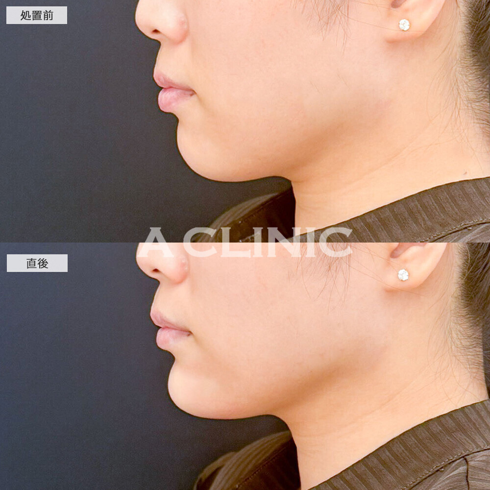 あごへのヒアルロン酸注入なら術直後から横顔が綺麗に整います！こちら処置前と直後の症例です(30代女性)