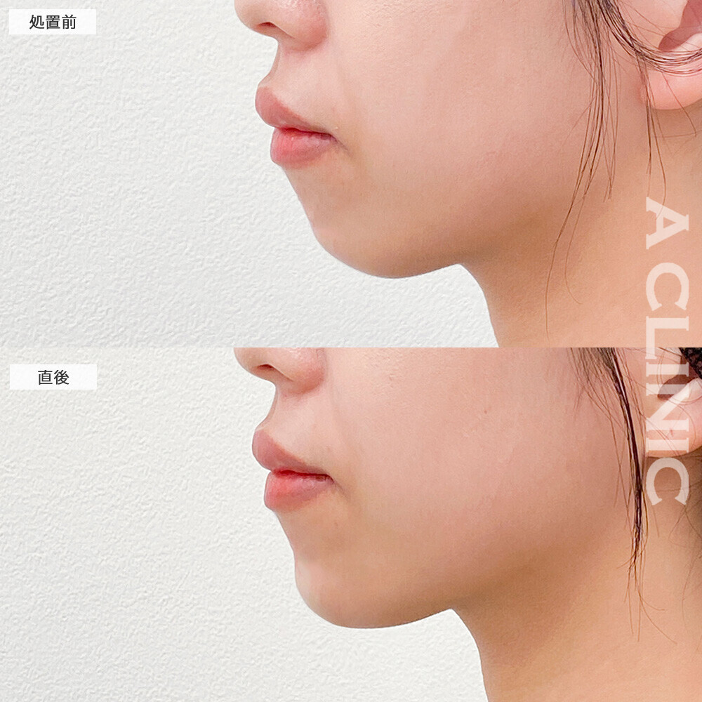 あごへのヒアルロン酸注入で口元の突出感が軽減され整った横顔に！こちら処置前と直後の症例です(30代女性)