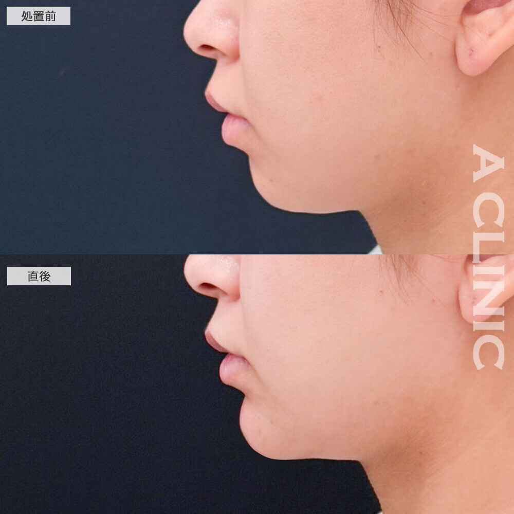 あごへのヒアルロン酸注入で横顔の立体感がアップ！こちら処置前と直後の症例です(20代女性)