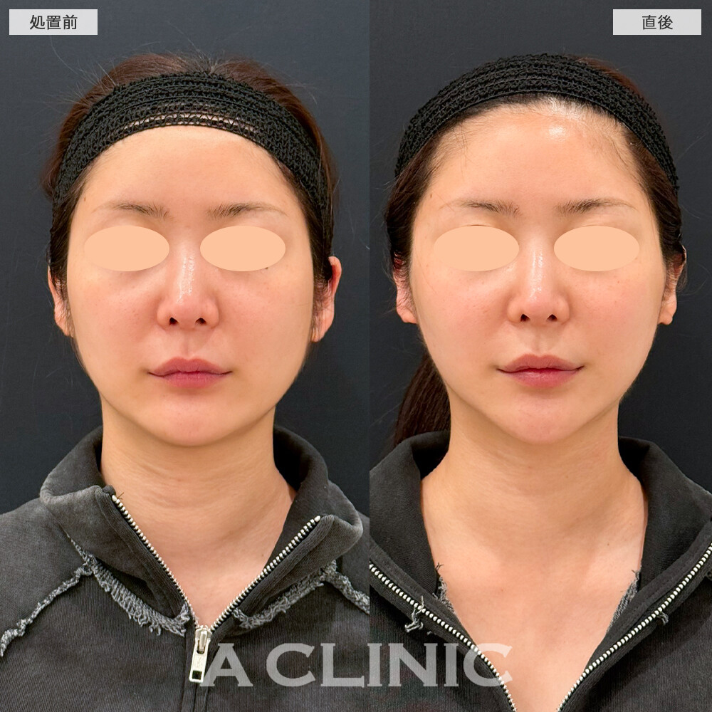Aスレッドで左右差が改善し、すっきりした輪郭になりました。処置前と直後の症例です(20代女性)