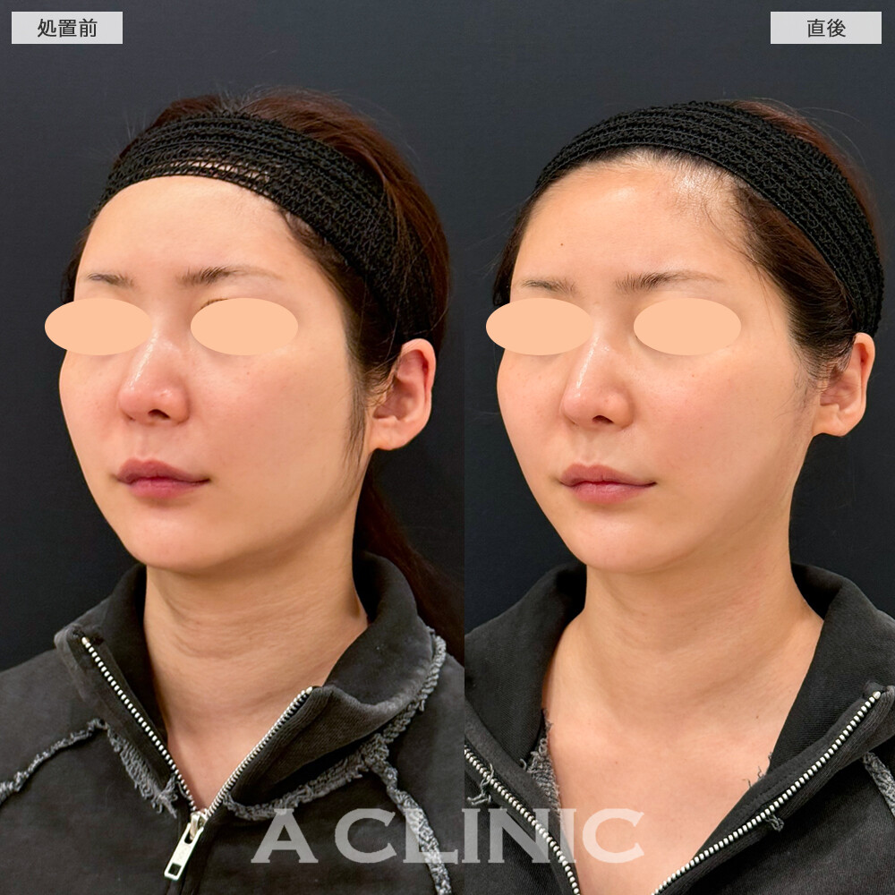 Aスレッドで左右差が改善し、すっきりした輪郭になりました。処置前と直後の症例です(20代女性)