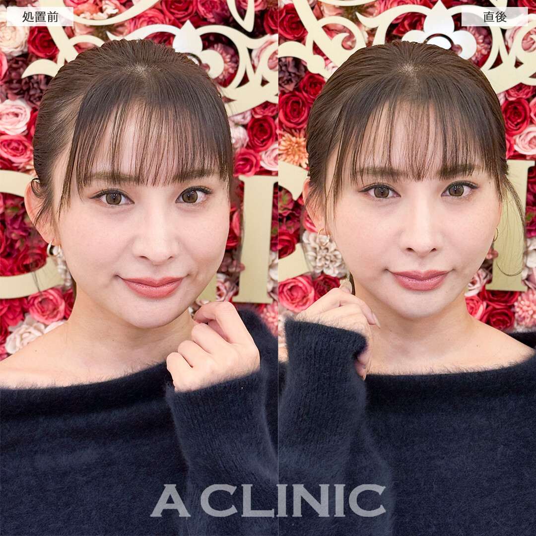Aスレッドでたるみの無い若々しい輪郭へ！処置前と直後の症例です(30代女性)