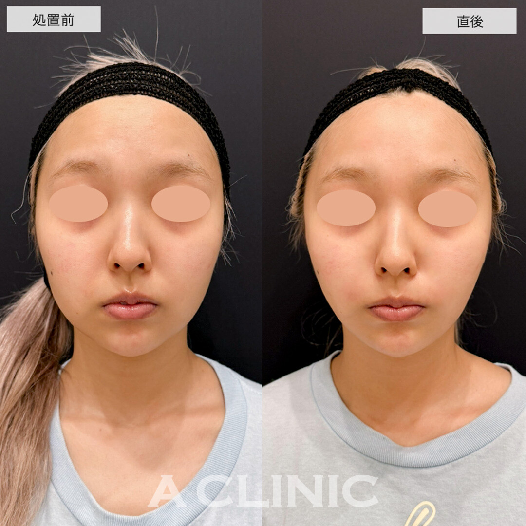 Aスレッドとヒアルロン酸注射を組み合わせて腫れ最小限で理想の輪郭に!こちら処置前と直後の症例です(20代女性)