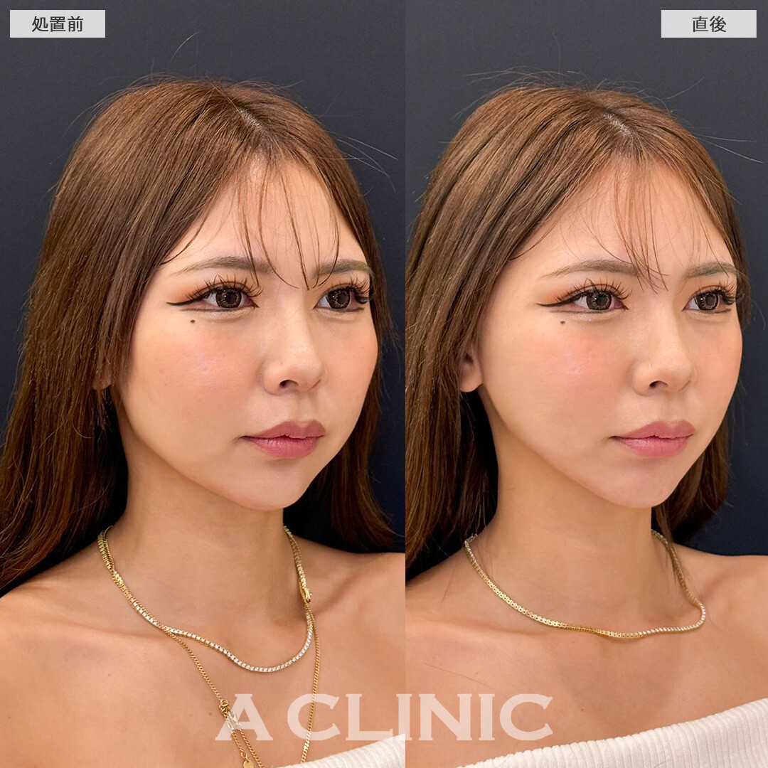 Aスレッドを定期的に受けることでたるみも怖くない！こちら処置前と直後の症例です(30代女性)