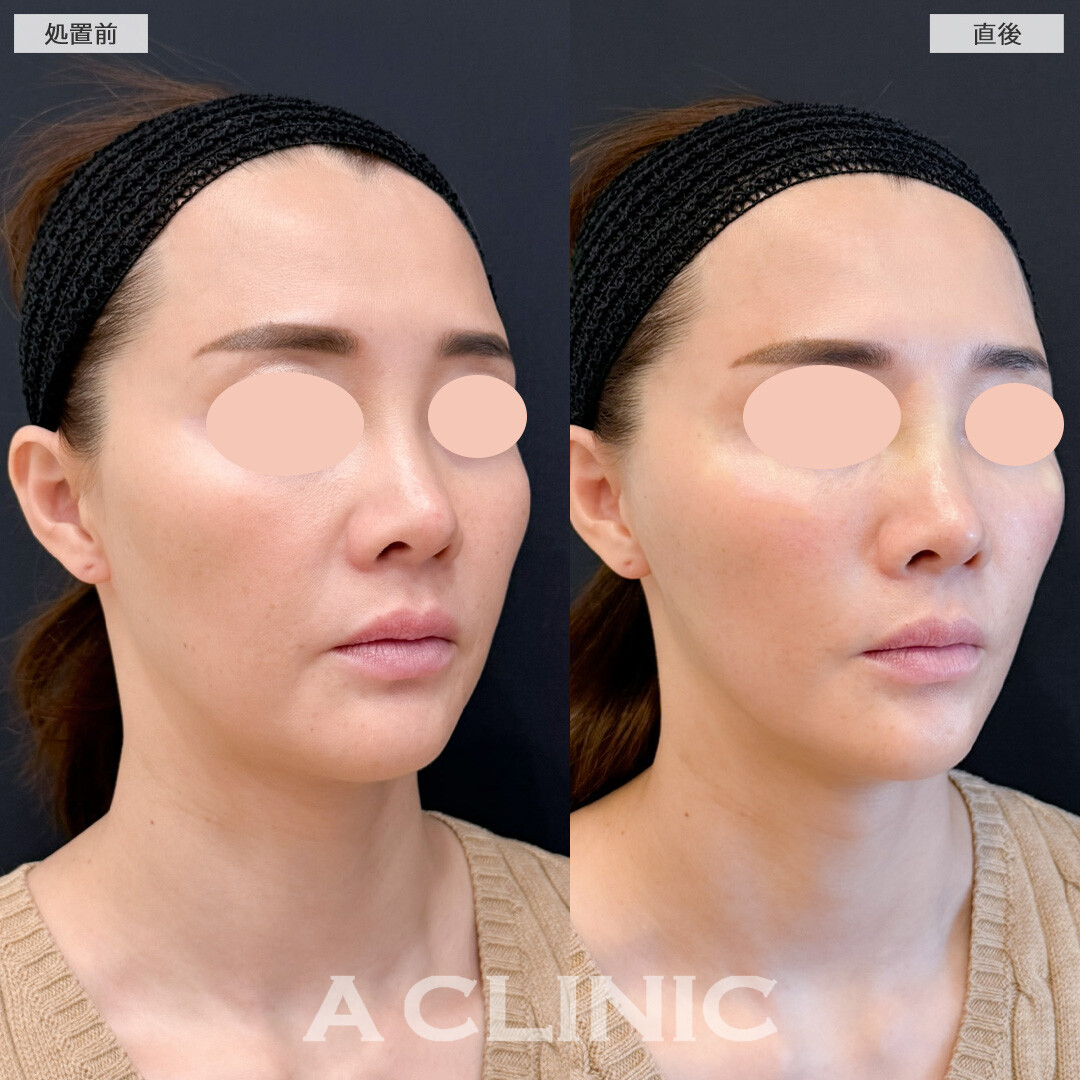 Aスレッドでもたつきなくして理想のフェイスラインへ！こちら処置前と直後の症例です(40代女性)